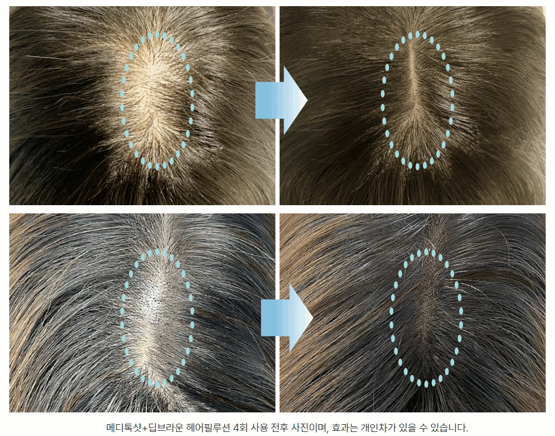딥브라운 전후사진비교.gif