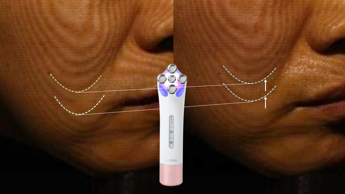 Up to 110% Instant Skin Firmness Boost｜Clinically Proven Pure [RF Radiofrequency Shot]