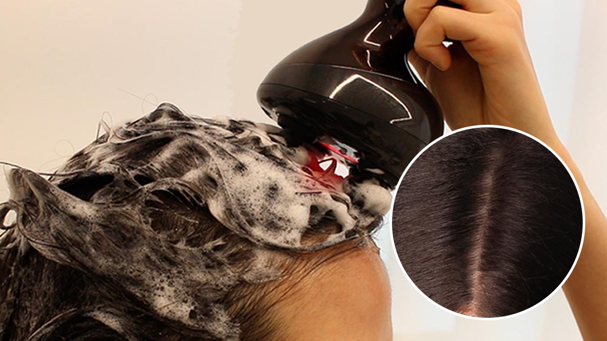 3周内头发脱落改善77.45%！头皮脱发护理终极方案