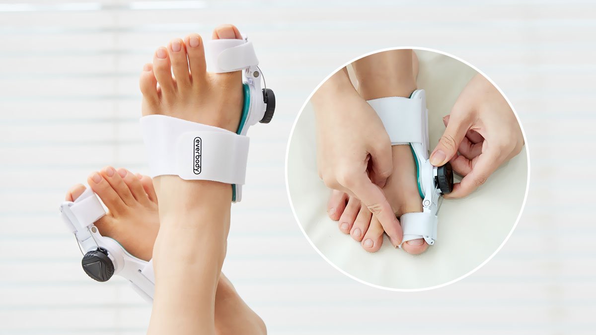 拇外翻？没错，能矫正！旋钮调节式无钢圈定制矫正器