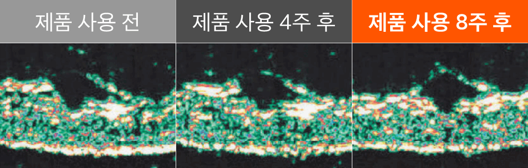 진피와피하지방층경계면길이(노란선).gif