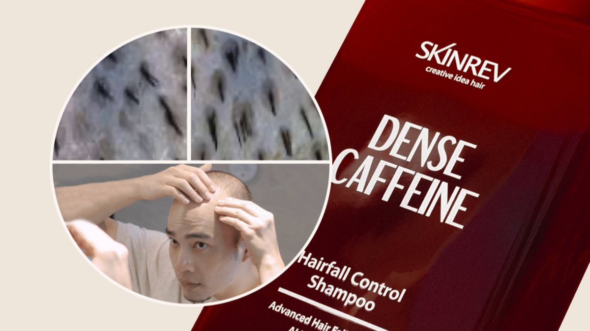 모낭 1개 5개의 머리카락이 자란다고?ㅣ탈모관리 포기하신분 손드세요.