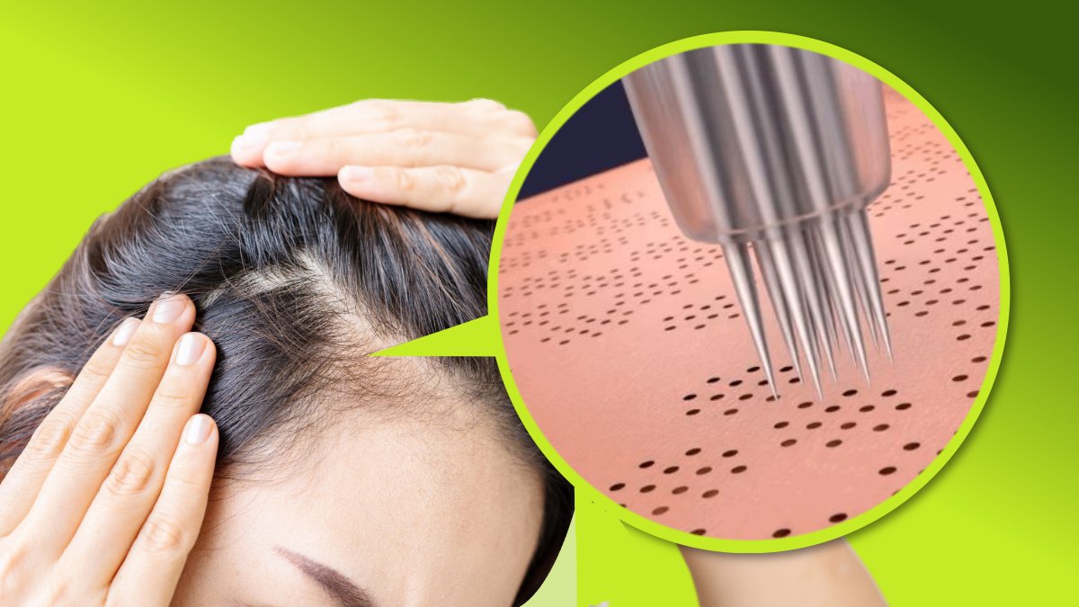 [3억앵콜] 흑채 아니고 문신 아니고 두드리면 채워지는 특허받은 두피앰플