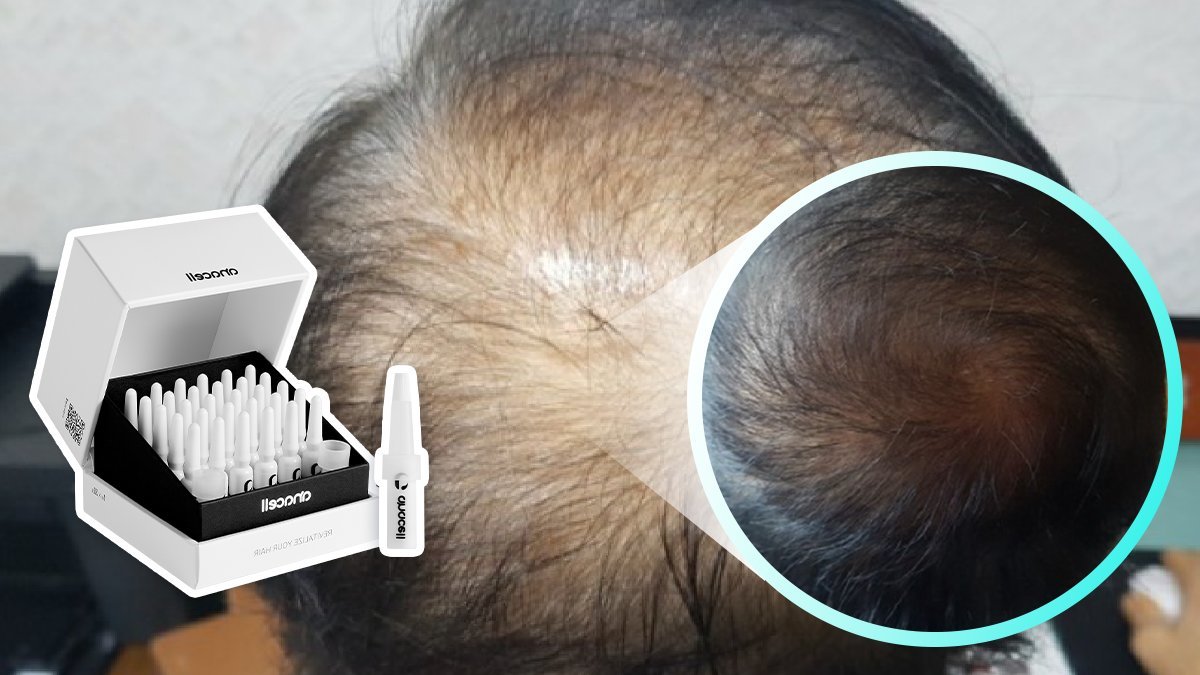 역대급 탈모24주임상으로 모발수8%개선? 1600만원 앰플 1병에 쏙-!