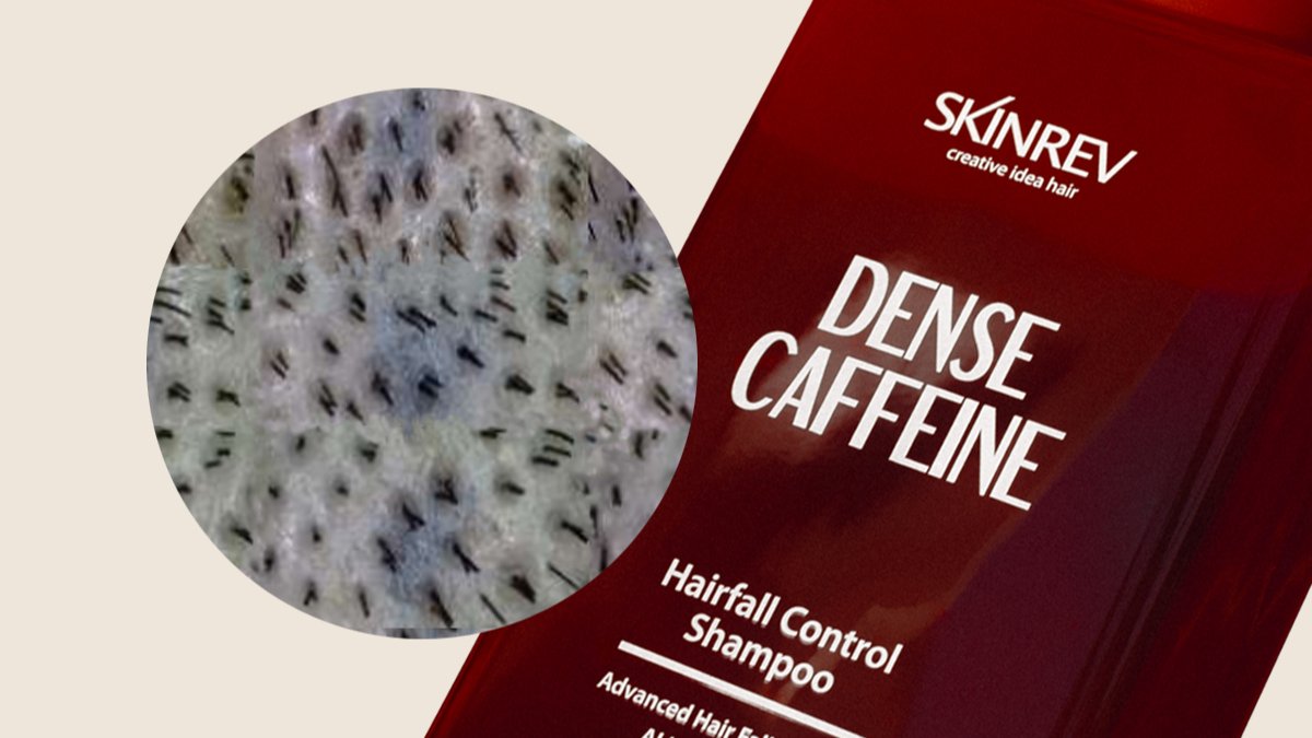 모낭 1개 5개의 머리카락이 자란다고? | 탈모관리 포기한신분 손드세요.