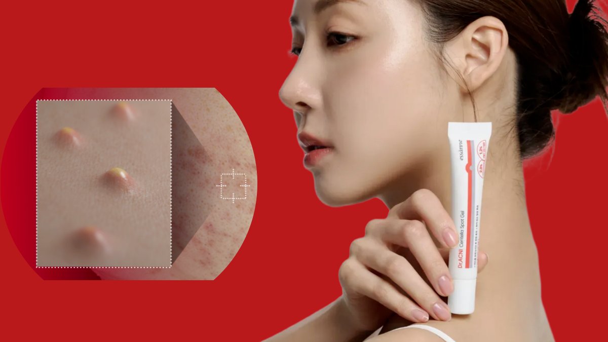 [6小时镇静]皮肤科痘痘处方秘方，急救祛痘凝胶