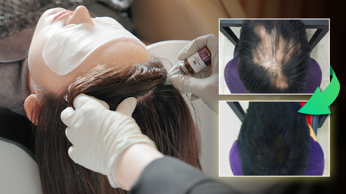 The secret to celebrities' thick hair! Gangnam Main Branch 1:1 customized scalp clinic