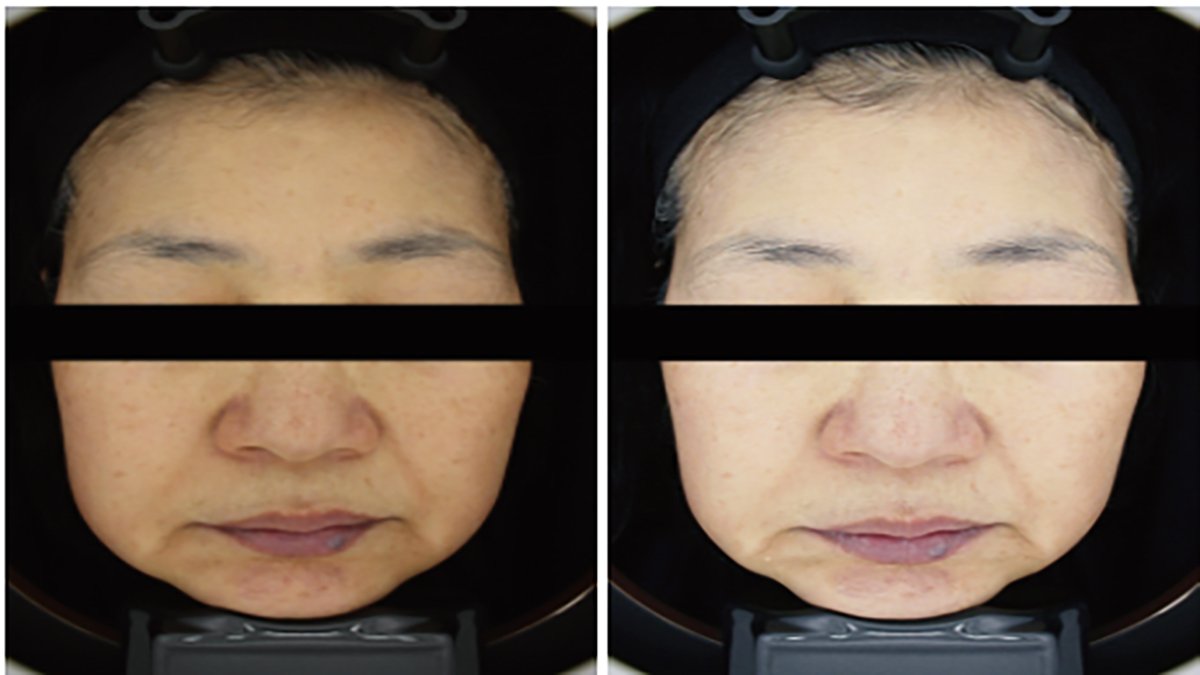 [Skin Tone Improvement After Cleansing] Just by cleansing my skin texture has completely changed.