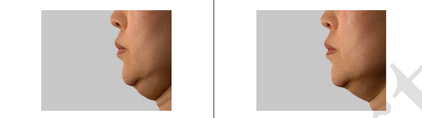 턱 밑 처짐 측정결과사진4.png