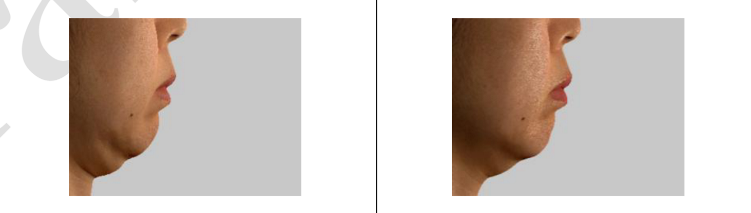 턱 밑 처짐 측정결과사진6.png