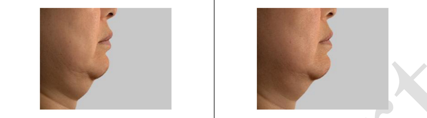 턱 밑 처짐 측정결과사진5.png
