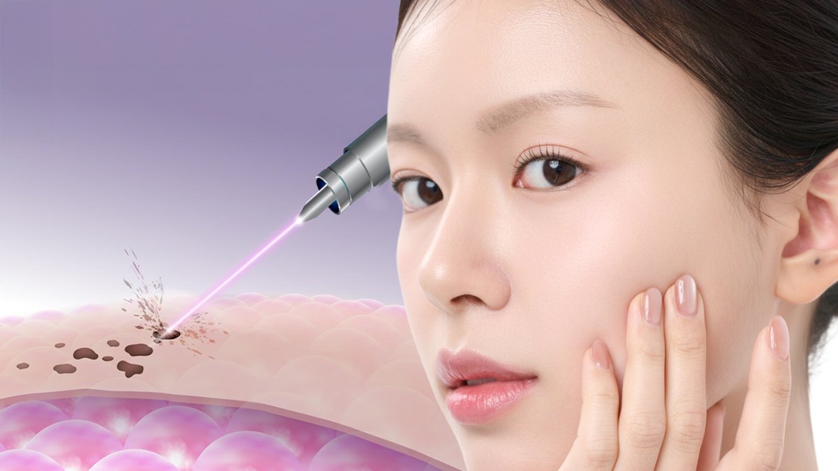 점 빼고 다 빼드립니다ㅣ여드름 흉,기미,모공까지? 2주안에 빼는 임상증명